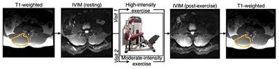 IVIM Imaging of Paraspinal Muscles Following Moderate and High-Intensity Exercise in Healthy Individuals